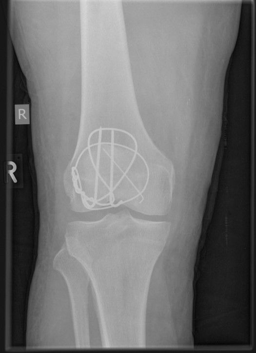2019-07-18.kniefrontal.jpg