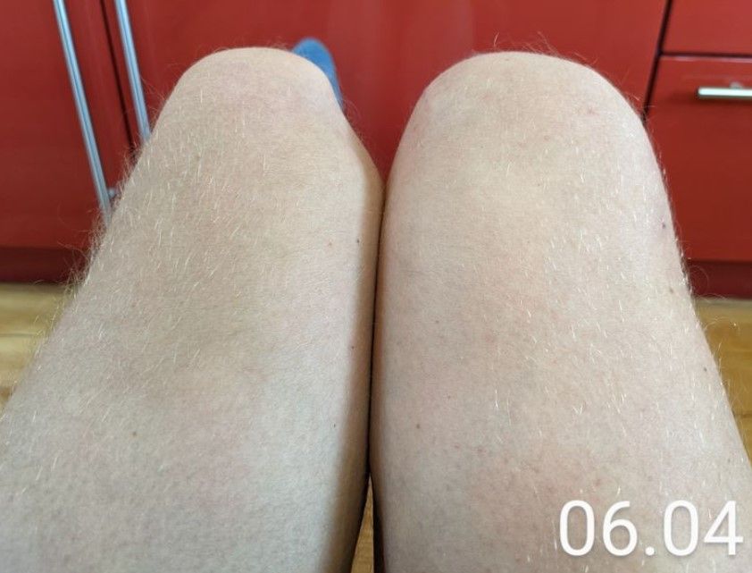 Knie dicker.jpg