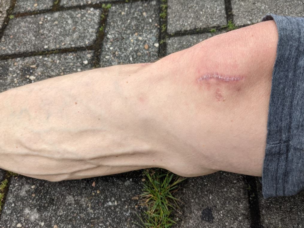 Knie mit Bakerzyste.JPG