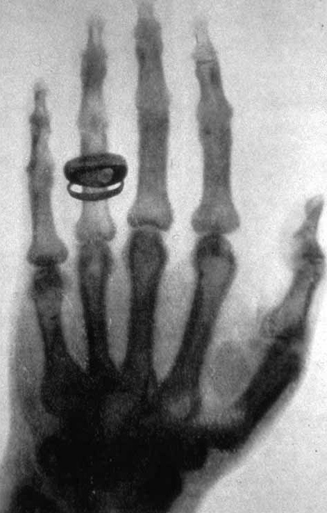 X-ray_by_Wilhelm_R%C3%B6ntgen_of_Albert_von_K%C3%B6lliker%27s_hand_-_18960123-02.jpg